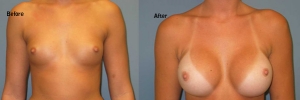 Breast Augmentation