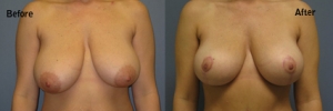 BreastLift2