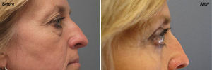 Eyelid Surgery