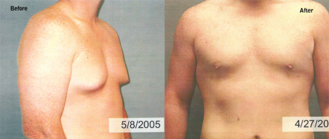 Male Breast Gynecomastia