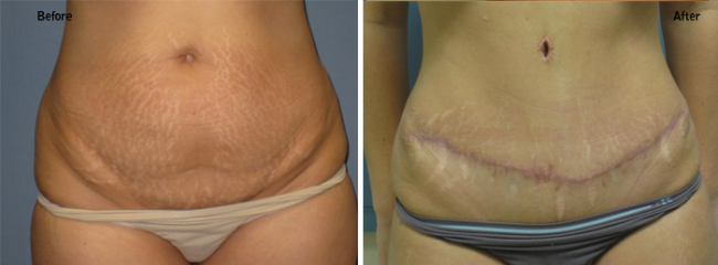 Tummy Tuck