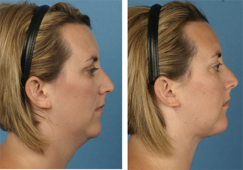 Neck Lift